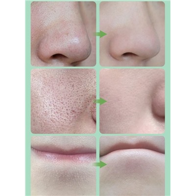 Набор сывороток очищения от черных точек и сужения пор Bisutang Suction Blackhead Remover, 2 шт. * 10 мл.